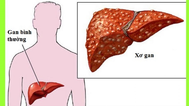 Người bị xơ gan làm giảm nống độ selen